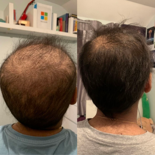 "I had cancer for a year & successfully ended my intensive chemotherapy treatment. Thank you for making me feel stronger again! These pictures are only 2 months apart. I wanted to show how Plantmade can give drastic results. Your products are amazing"<br>Raniyah