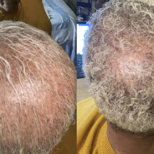 "Kai duo changed my life , For 6 years my hair has been thin. I have tried everything and after 3 WEEKS you can see the improvement."<br>Jackie